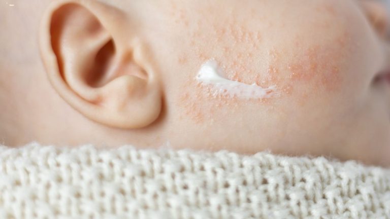 Nahaufnahme einer Babywange mit trockener Haut